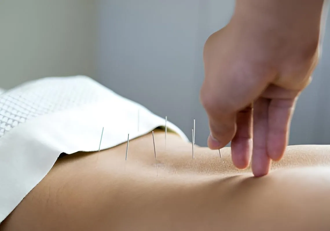Acupuncture